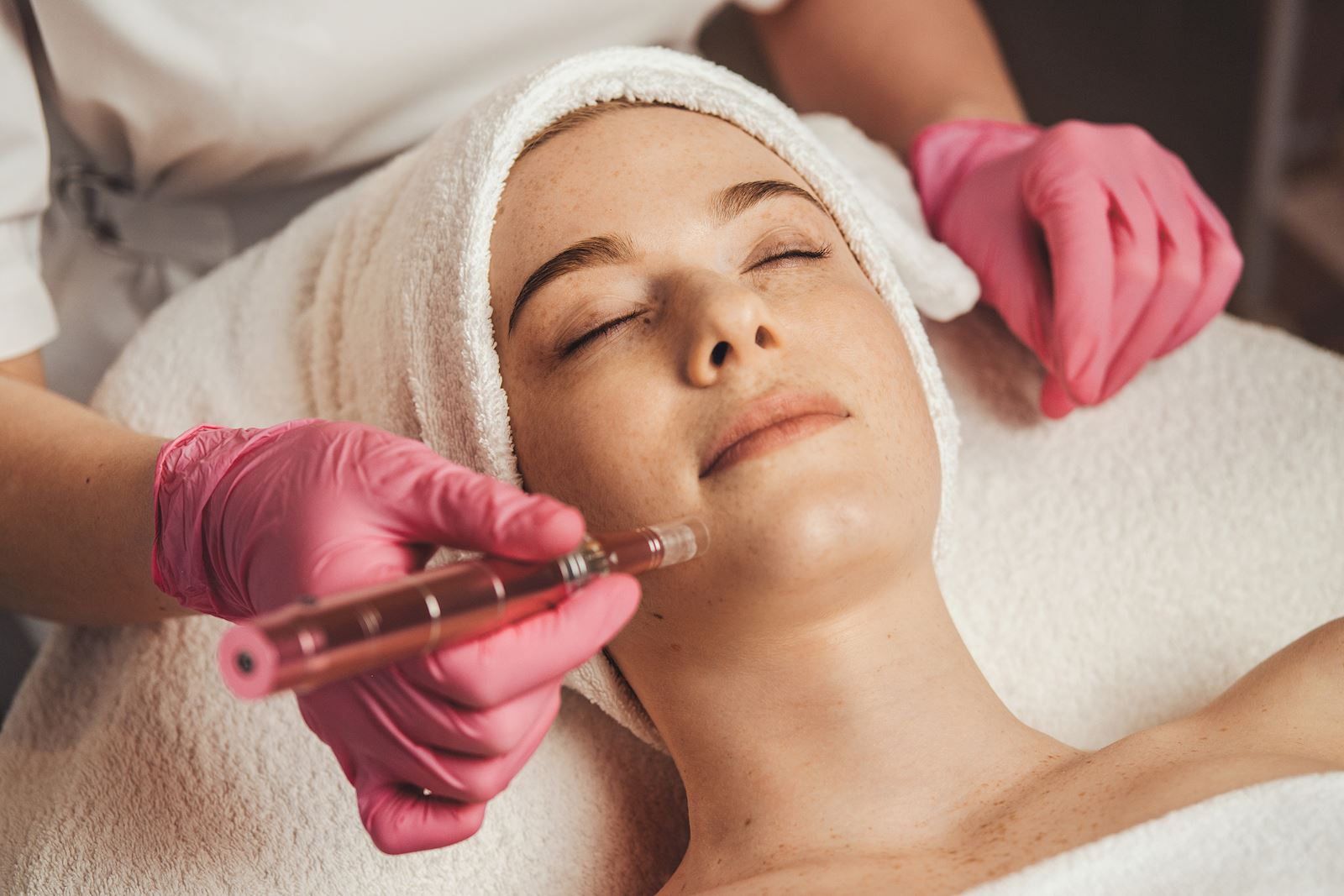 Microneedling1 groot
