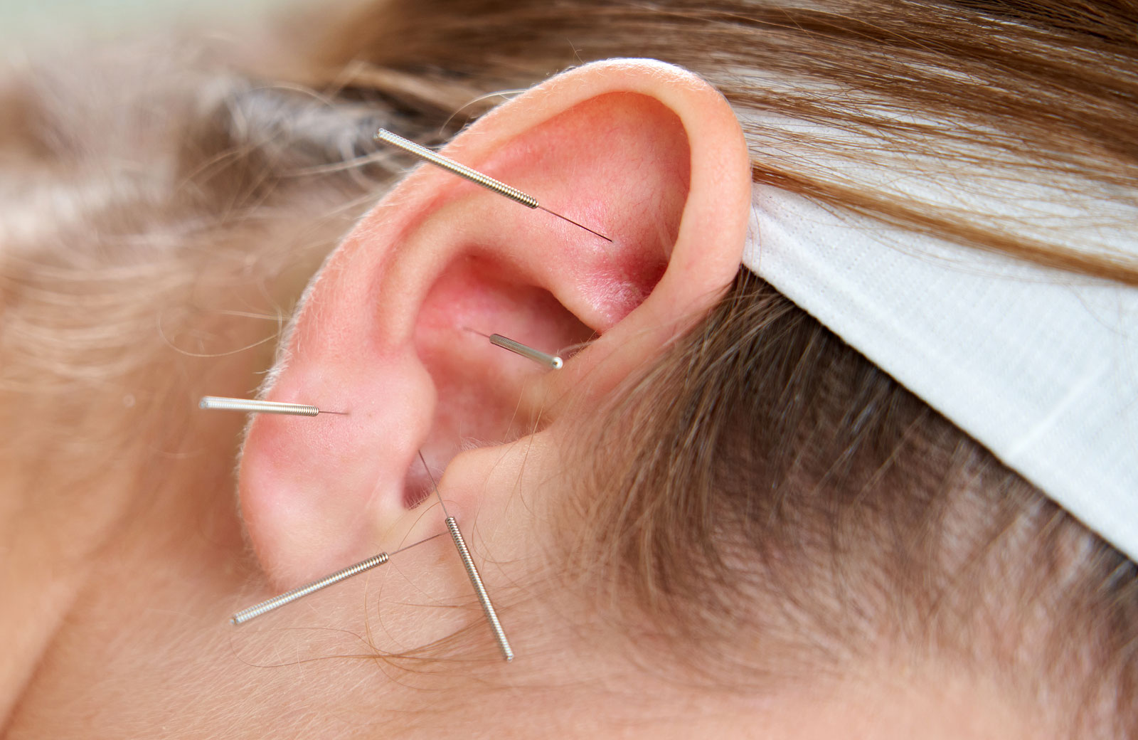 Stockfoto Acupunctuur in oor